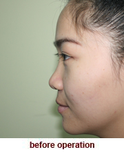 plastic_surgery_augmentation_rhinoplasty